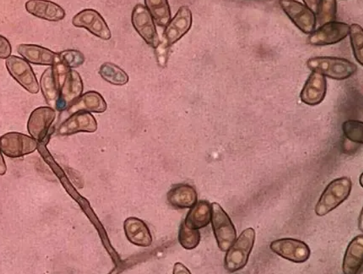 真菌染色液品牌:真菌荧光染色阴性是什么意思真菌阴性一定证明无菌吗