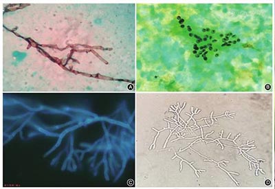 真菌感染，医院为什么会选择真菌荧光染色剂检测呢？